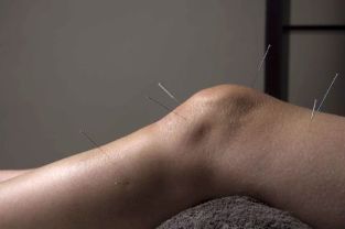 Акупунктурата промовира обновување на заедничкото ткиво